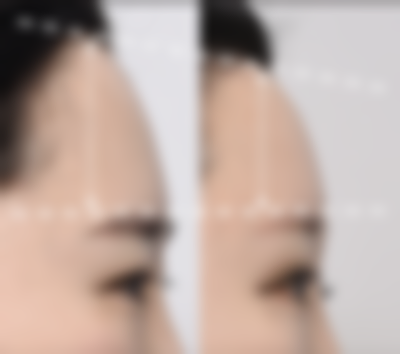 三点定位双眼皮手术部分开刀