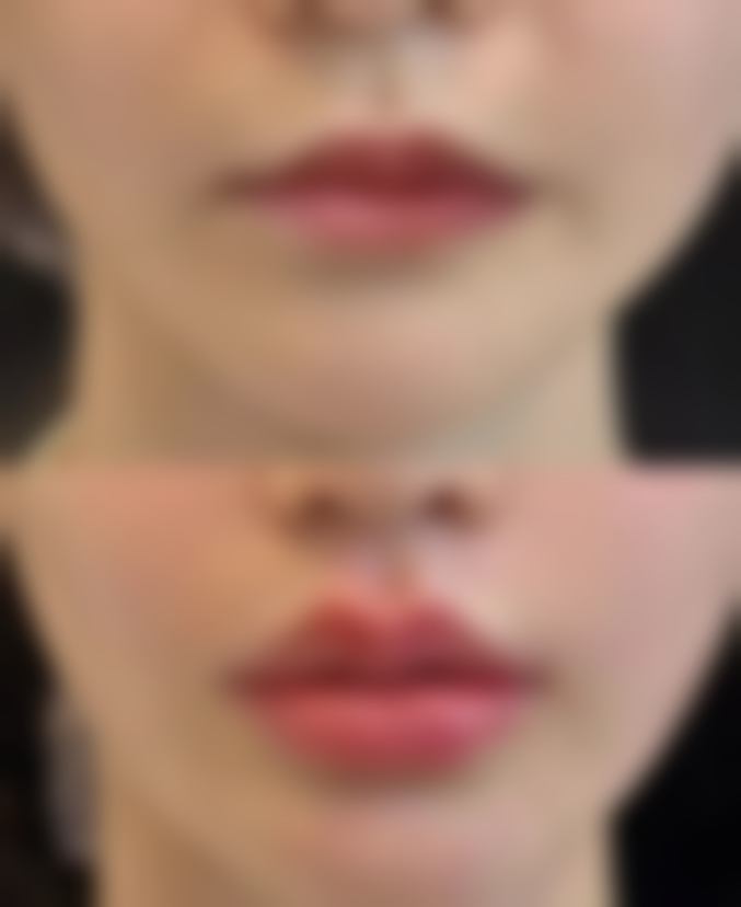 割完双眼皮后吃螃蟹的注意事项