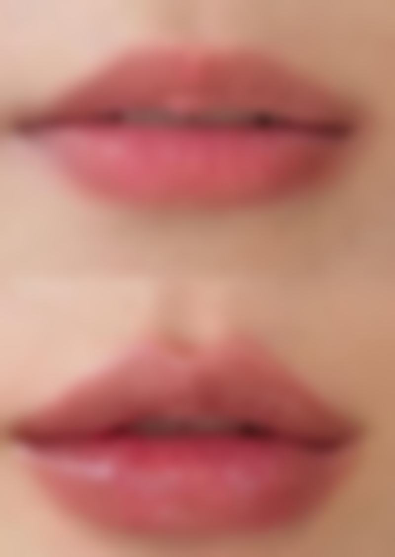 压迫治疗去除缝合后的疤痕