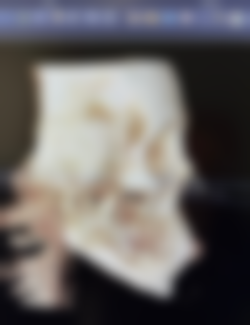 激光祛眼袋的价格是多少