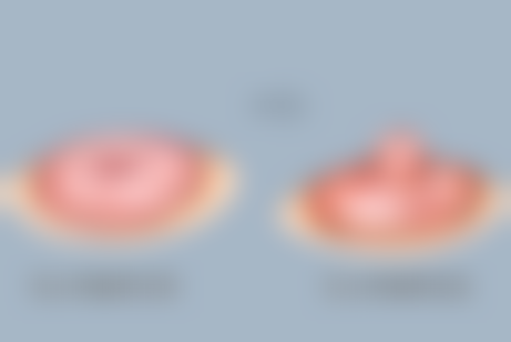 打除皱针停针后会加速衰老吗