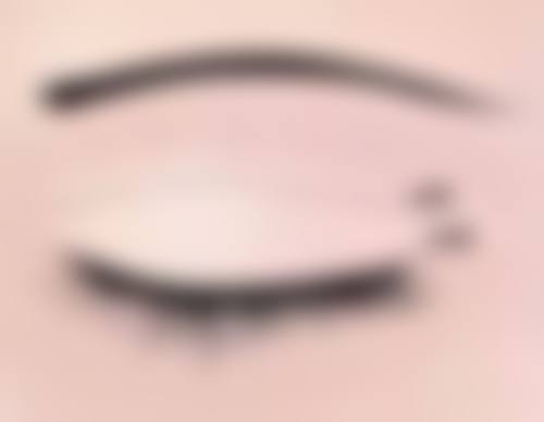 不同切眼袋方法的影响差异