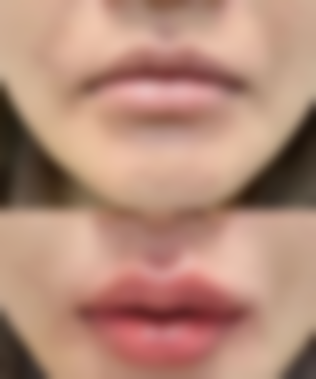 玻尿酸隆胸的优缺点总结