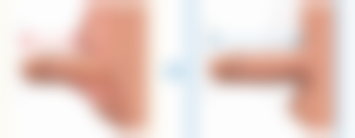 针剂治疗疤痕疙瘩的价格情况