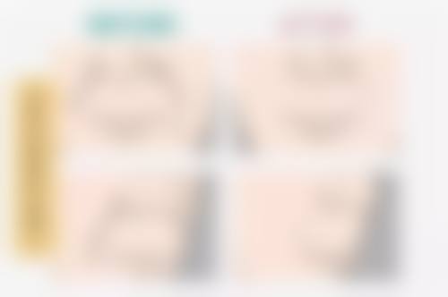 双眼皮宽改窄修复的可行性与哪些因素有关