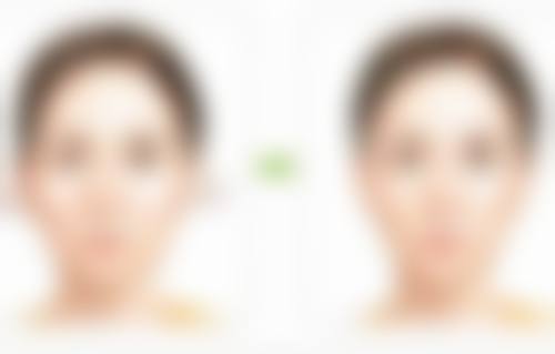 隆鼻假体可能造成皮肤坏死