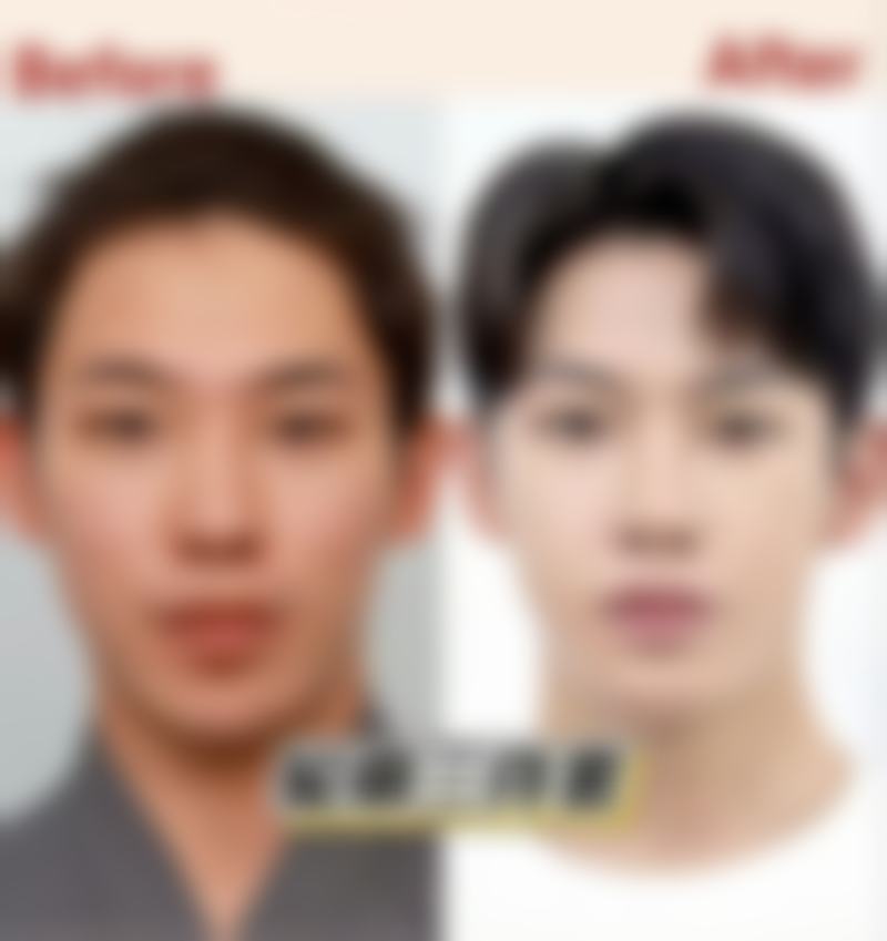 激光治疗擦伤疤痕