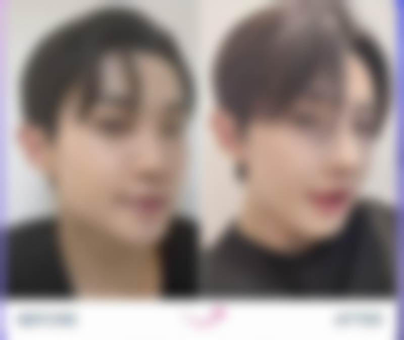 打瘦脸针一周后吃消炎药的情况