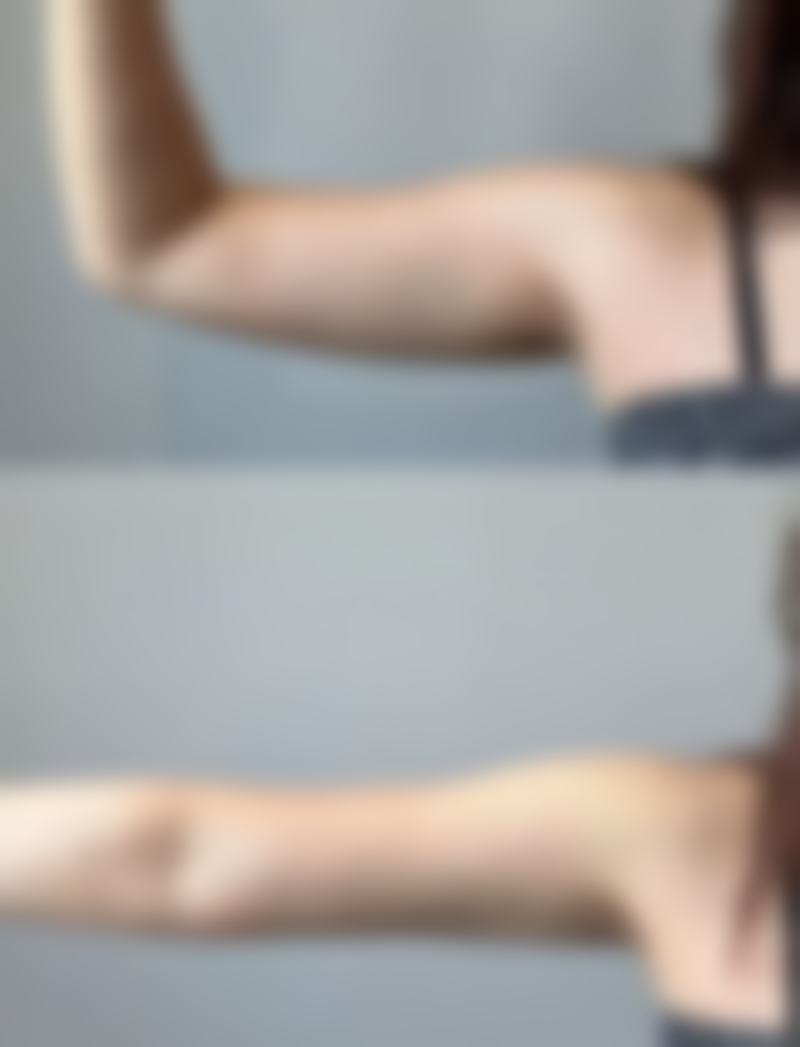 不同类型疤痕膏的特点