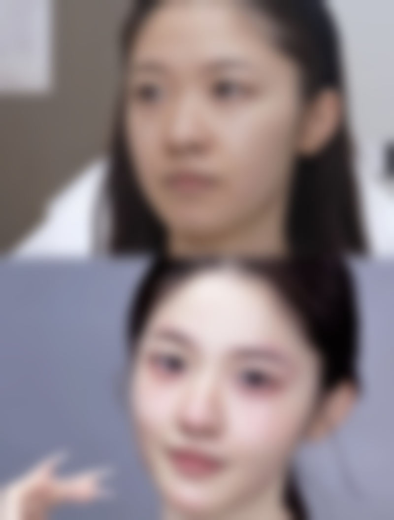 术后护理对黑眼袋手术成效维持时间的作用