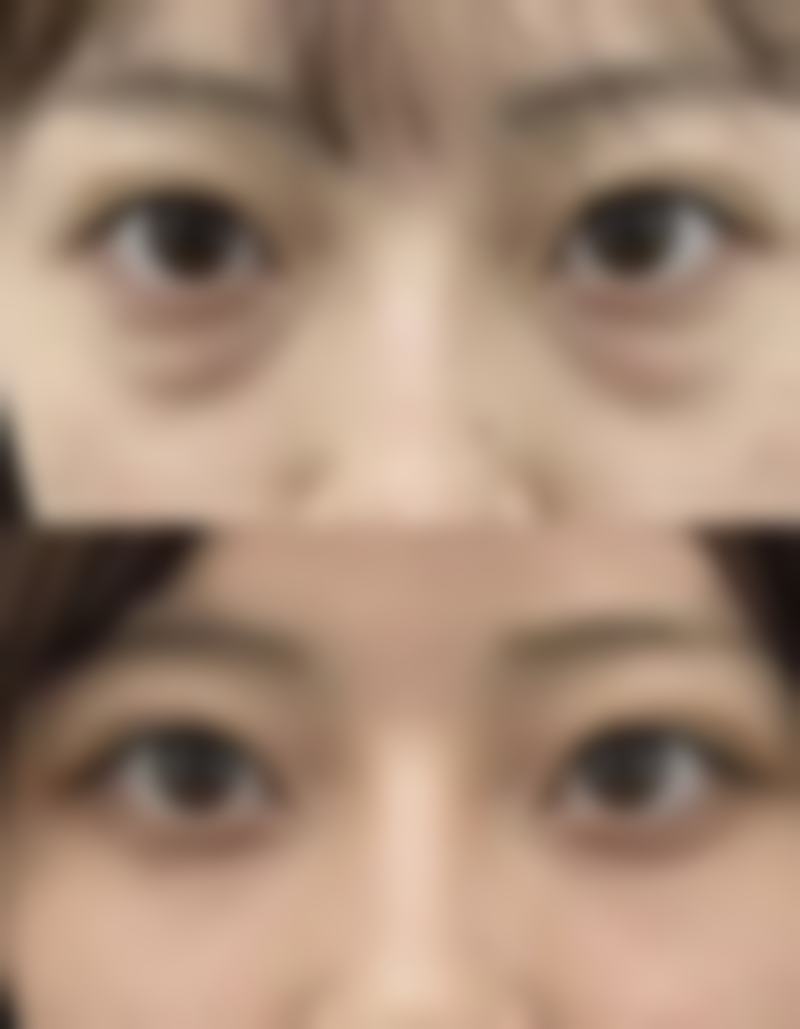 溶脂去眼袋多久见成效