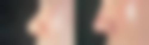 下颌骨整形的修复时间怎么样