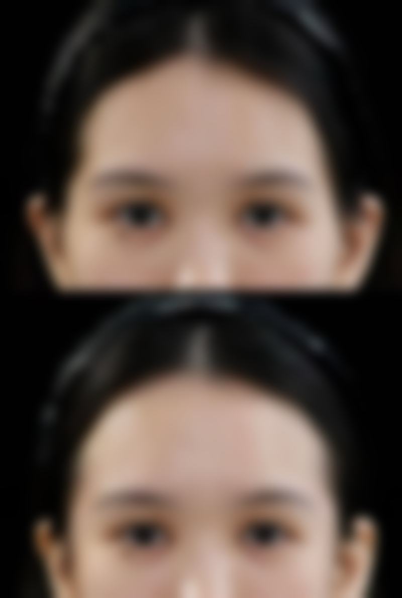 第二次眼袋手术的风险和注意事项