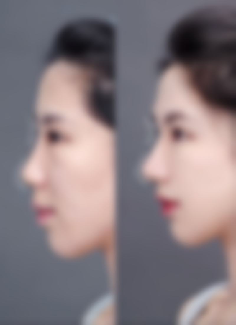 双眼皮手术各阶段疼痛情况