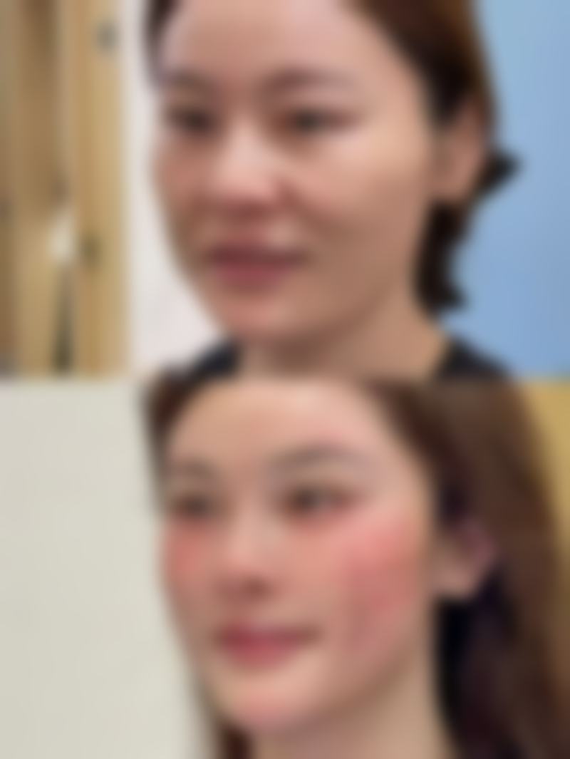 眼袋玻尿酸填充的适用人群