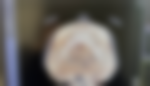 激光治疗点痣后疤痕