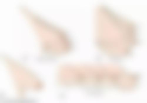 开双眼皮全切修复期的注意事项