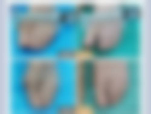 手术治疗被油烫伤的疤痕