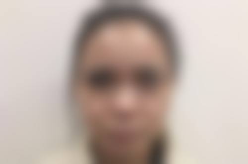 割完双眼皮后不同阶段对韭菜的食用建议