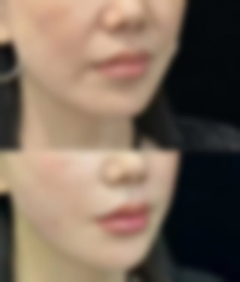 张倜然医生做双眼皮的口碑实例