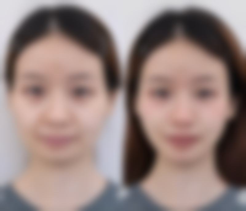 应对全切双眼皮增生的方法