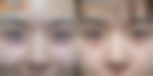 不同类型疤痕颜色淡化的情况