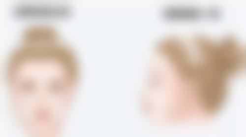 如果疤痕体质做了隆胸手术，如何处理疤痕