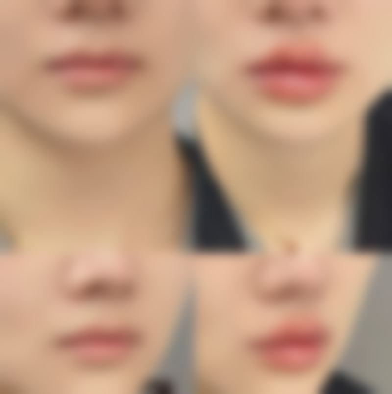 术后生活习惯对吸脂成效保持的关键作用