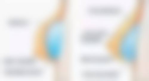 突出的疤痕治疗后成效如何