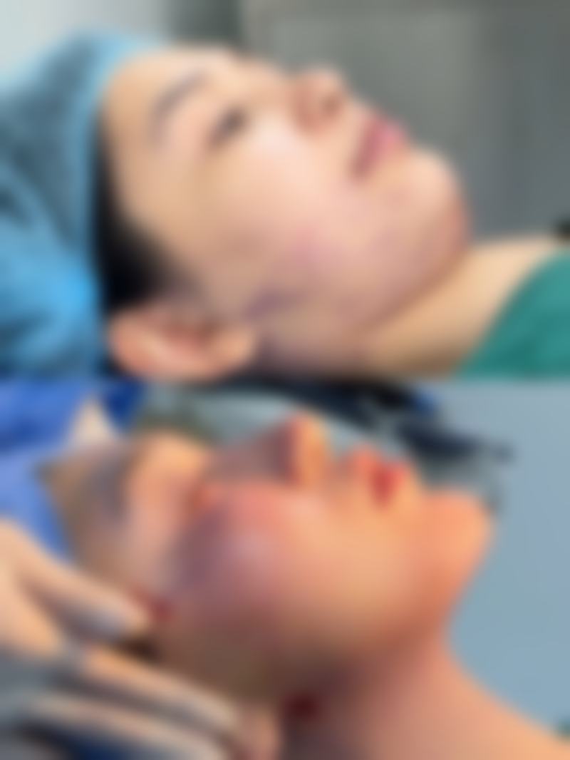 提高自体脂肪隆胸成效的方法