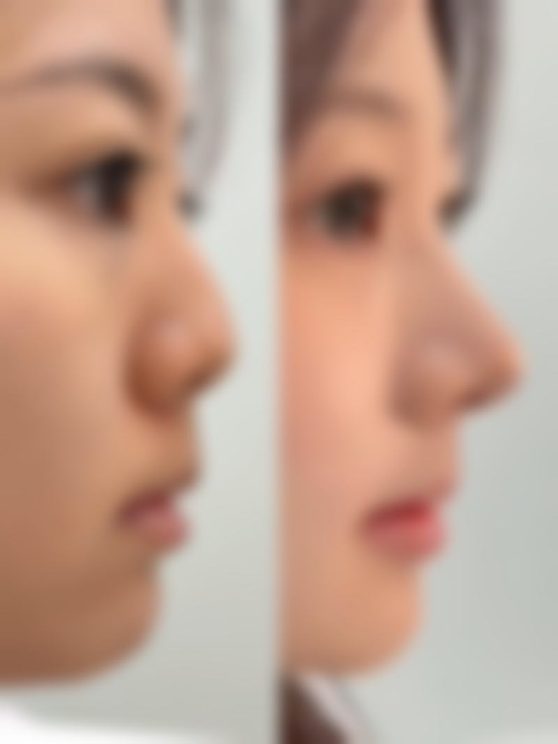 浅的凹陷疤痕修复过程中要注意什么