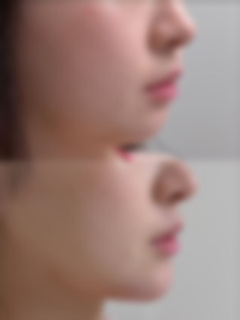 嘴巴疤痕去除的注意事项