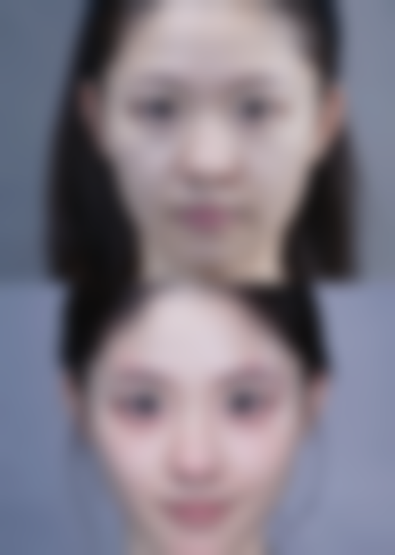 术后初期的应对方法：冰敷