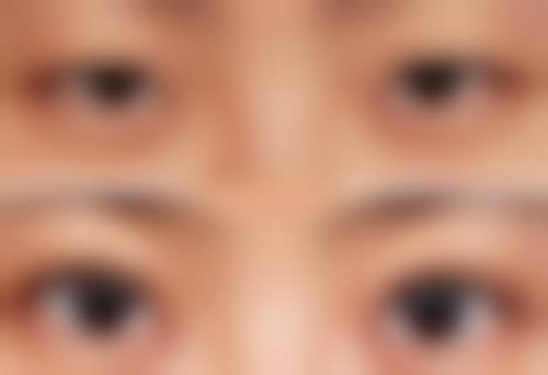 保妥适除皱的成效能维持多久