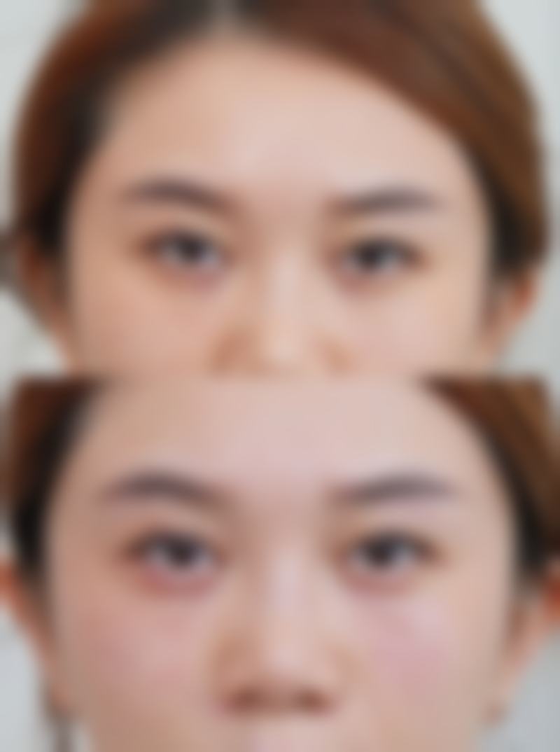 保妥适除皱的价格大概是多少