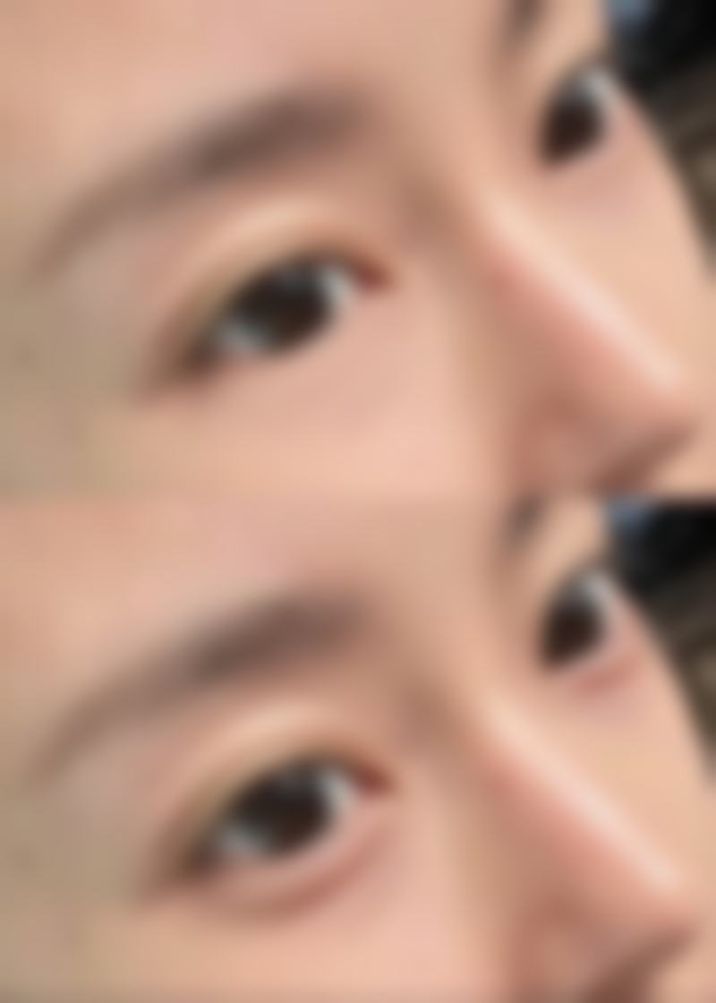 改善颧骨宽大的其他方法