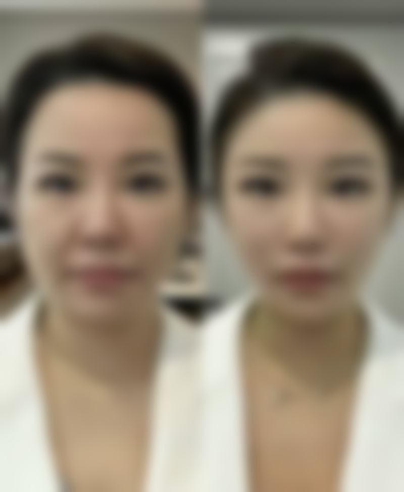 白色疤痕修复的注意事项