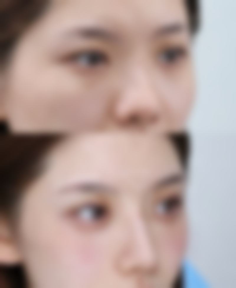如何降低割双眼皮割到神经的风险