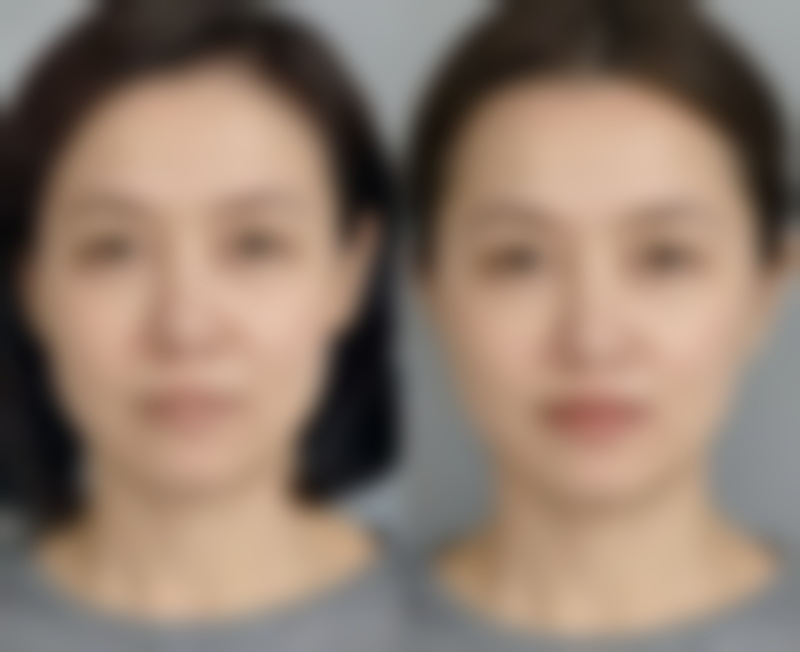 河源曙光植发医院技术好不好?