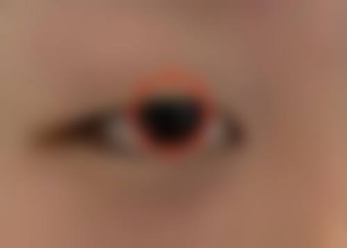 不同阶段烫伤疤痕的治疗策略