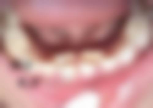 脸小的人做双眼皮的注意事项