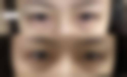 过敏反应导致的眼袋脸部浮肿