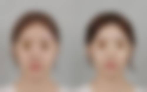 脸上缝针的疤痕能除掉吗之治疗时间选择