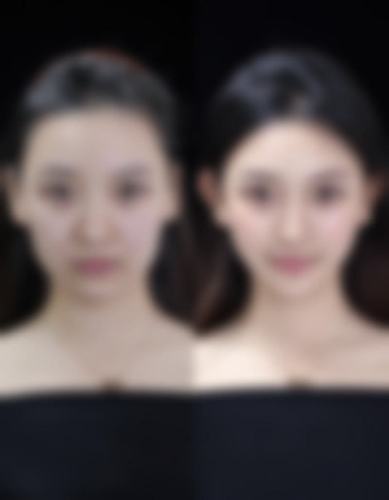 点阵激光治疗凹陷疤痕的费用