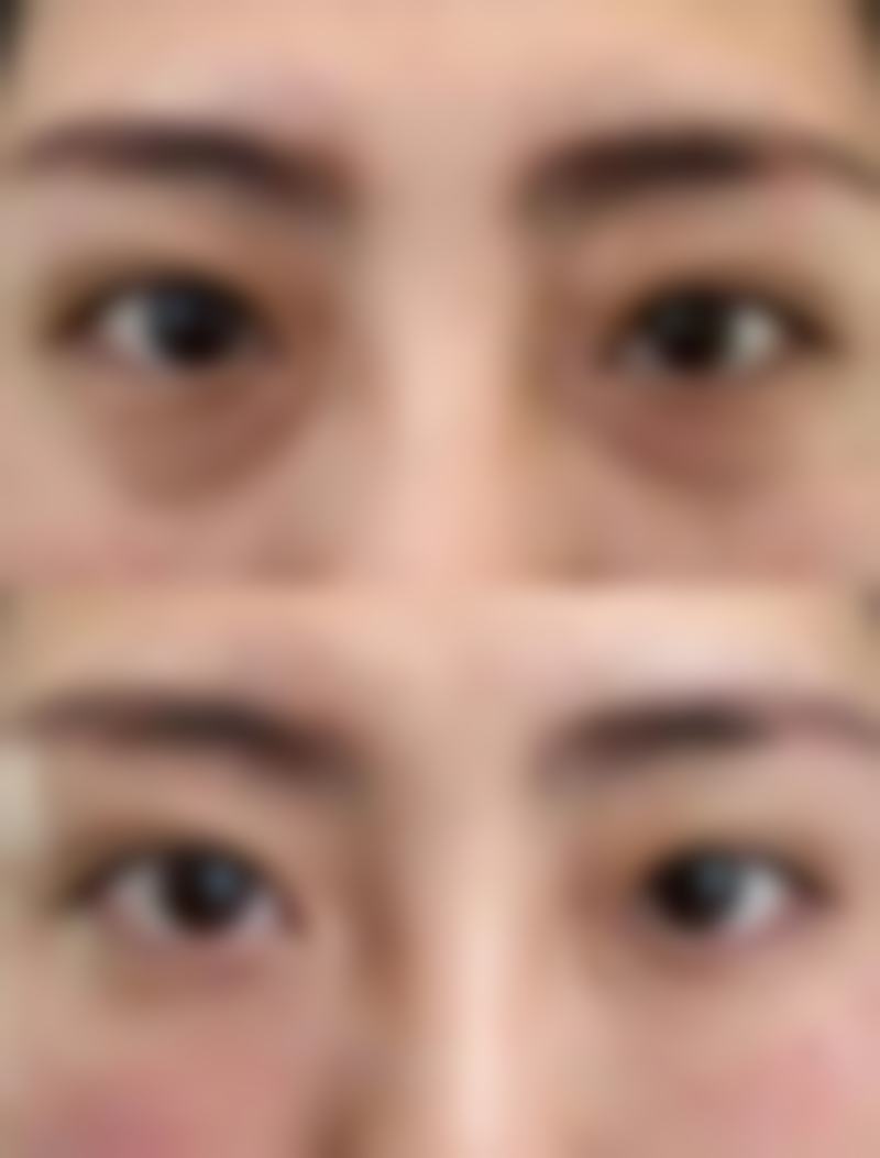 敷冰去眼袋的局限性