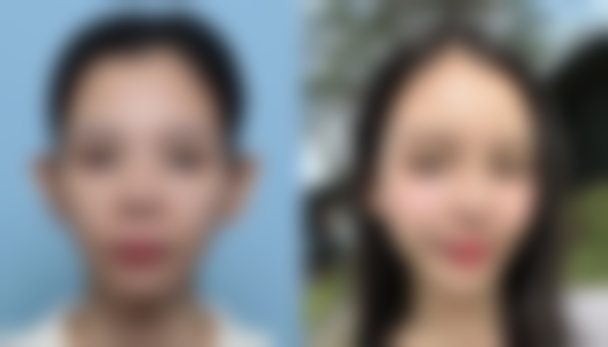 如何提高手臂吸脂300cc的变细成效