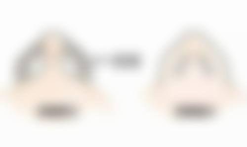 做过韩式三点双眼皮后不能再次手术的情况