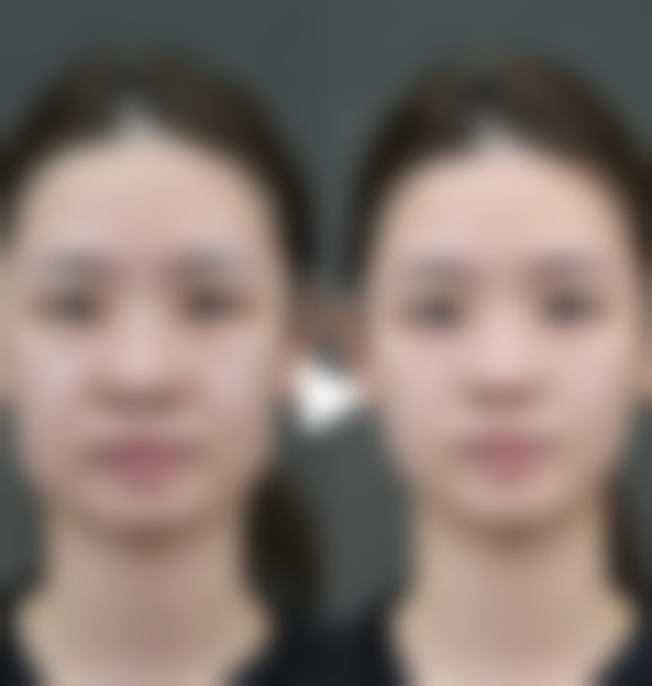 吸脂瘦肚子后要注意什么