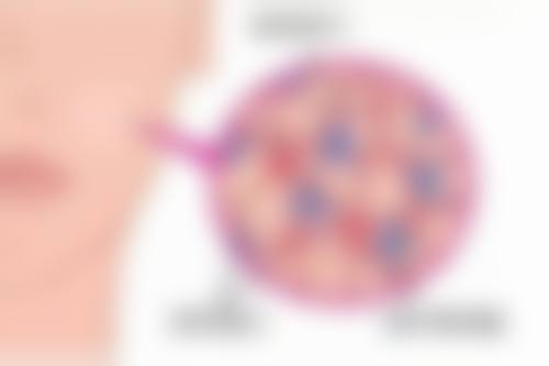 内吸眼袋会有淤青吗？术后为何会淤青、多久消退及如何减轻一文说清