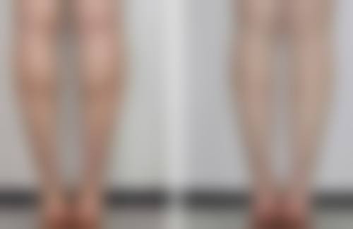 医生为何通常不建议只割一只